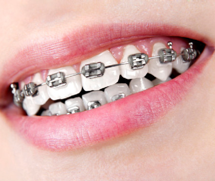 Orthodontics (Braces)